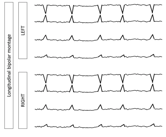 Lateralized Periodic Discharges