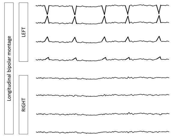 Bilateral Independent Periodic Discharges