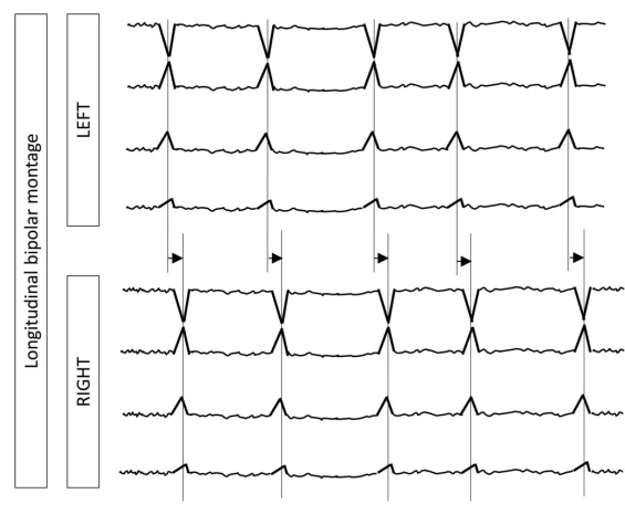 Multifocal Independent Periodic Discharges