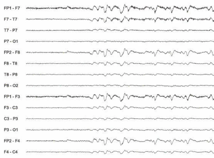 آرتیفکت گلوکوسینتیک