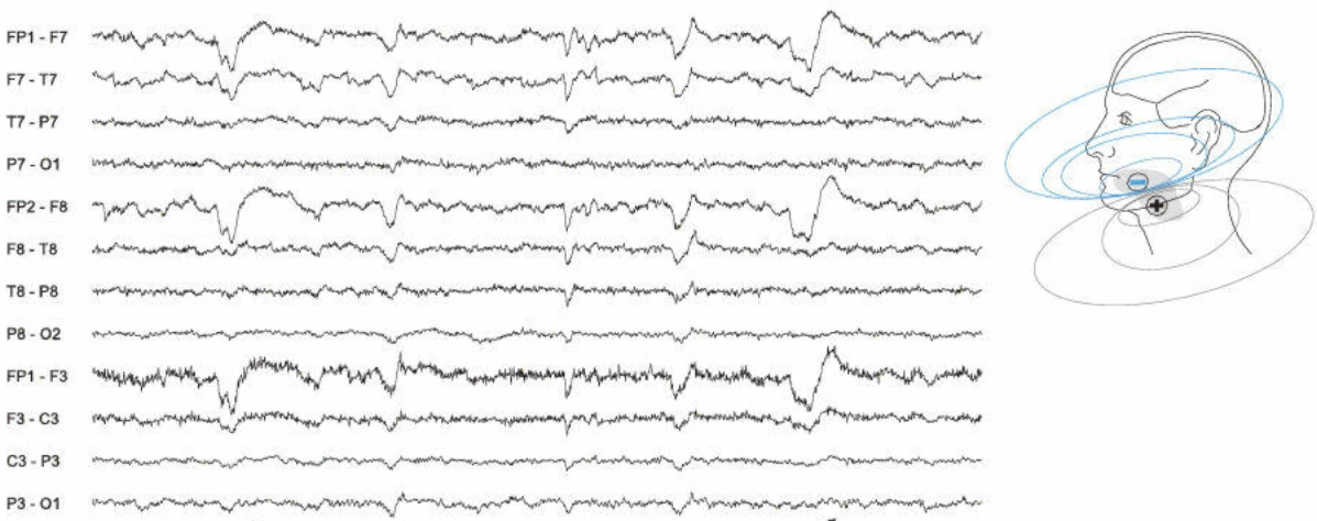 آرتیفکت گلوکوسینتیک
