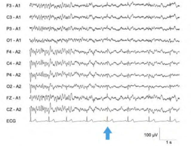 آرتیفکت ECG