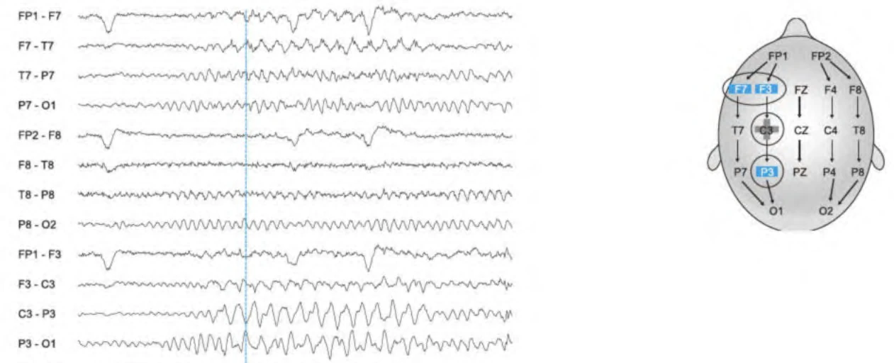 آرتیفکت لرزش سیم‌ها