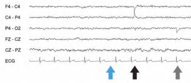 آرتیفکت پاپ الکترود