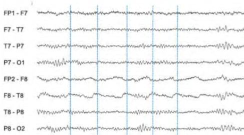 آرتیفکت نبض