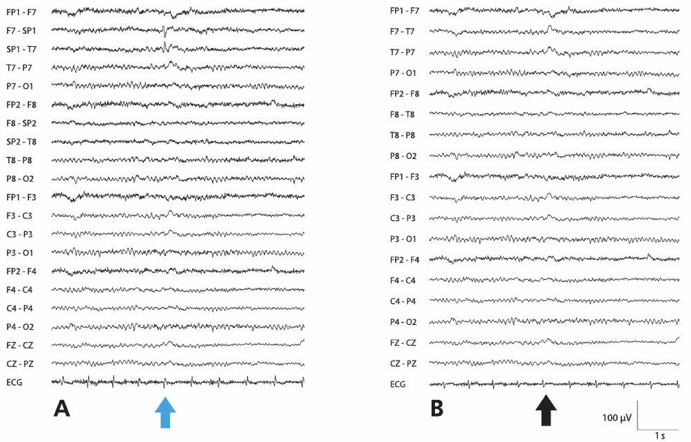 دشارژهای اسفنوئیدال