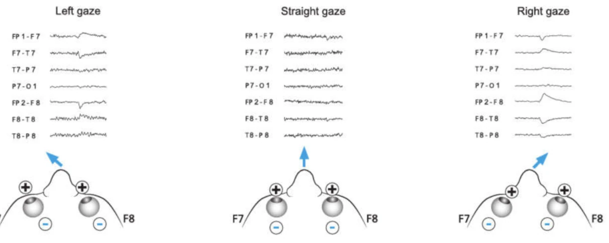 انحرافات EEG ناشی از حرکات چشم