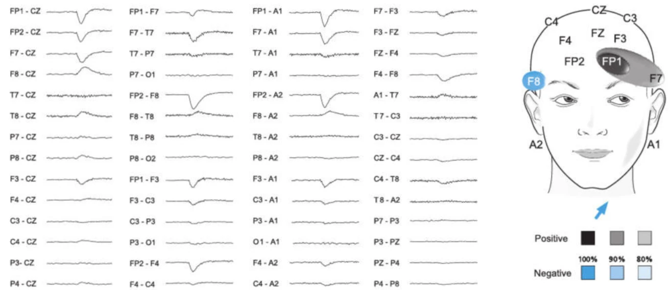 حرکت بولب هنگام نگاه به بالا و چپ