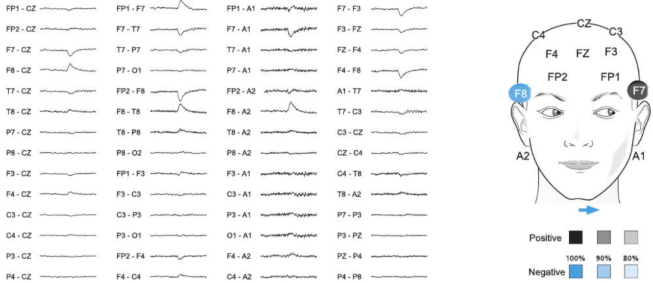 حرکت بولب هنگام نگاه به چپ