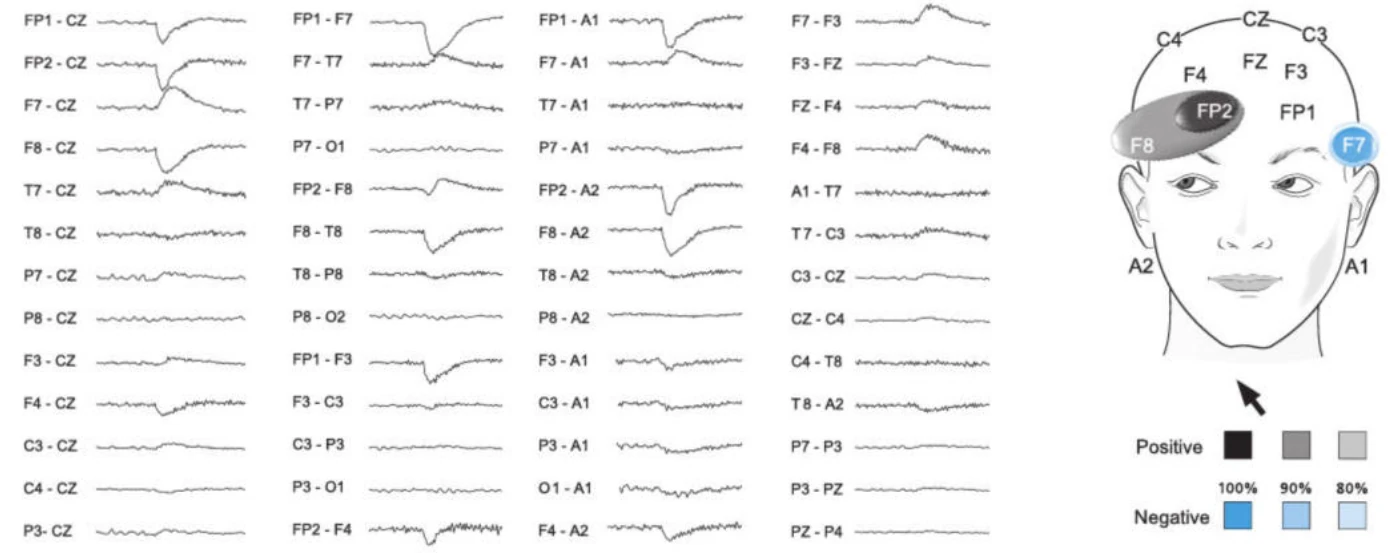 حرکت بولب هنگام نگاه به بالا و راست