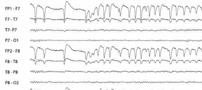 پلک‌زدن مکرر