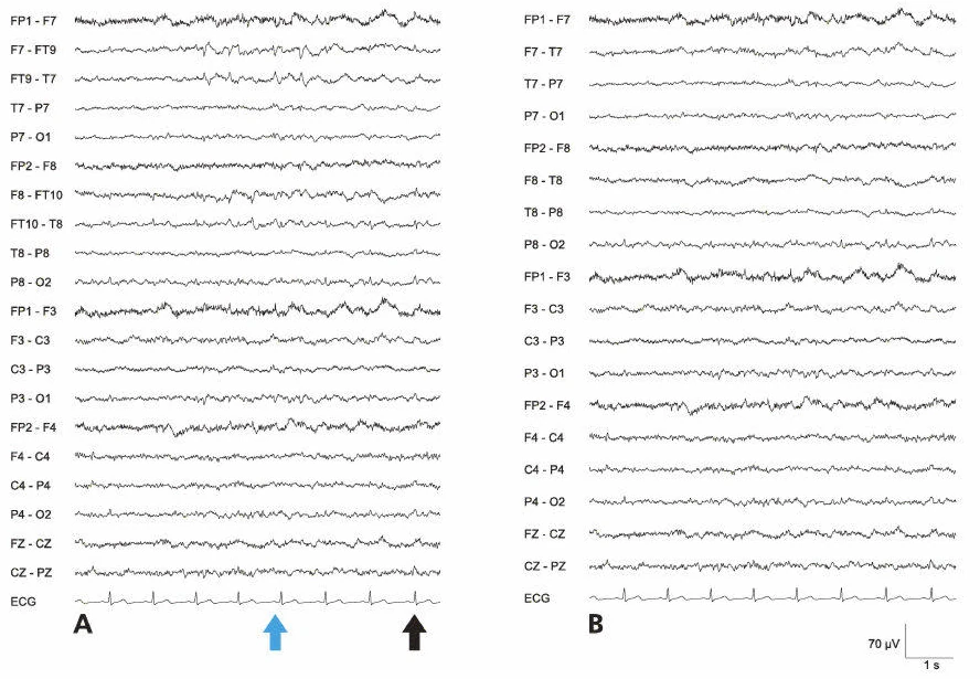 دشارژ تمپورال