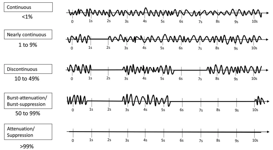 EEG Pattern Example