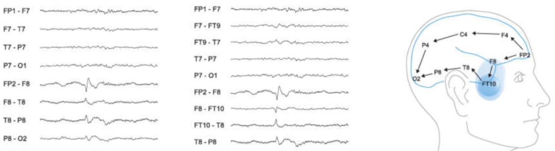 مزیت الکترود تمپورال قدامی