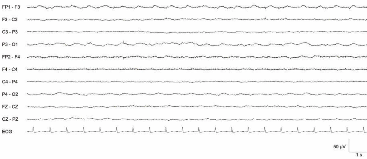 Background Suppression