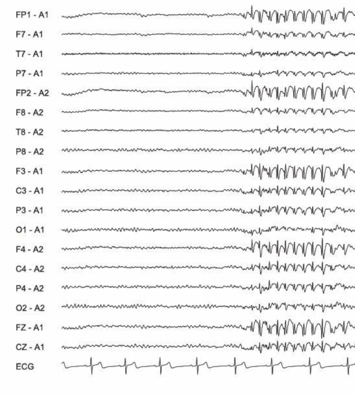 اسپایک-ویو، ژنرالیزه