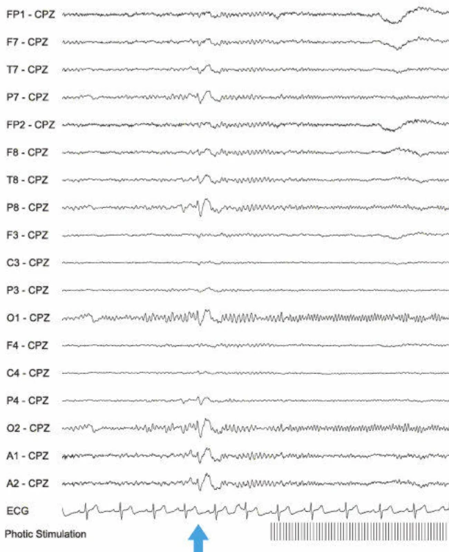 اسپایک‌ها، تمپورو-اکسیپیتال راست