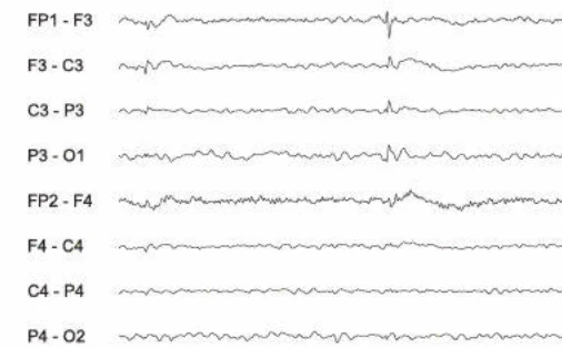 اسپایک‌ها، فرونتال چپ