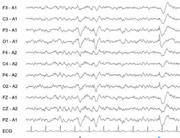 اسپایک‌ها، اکسیپیتال چپ