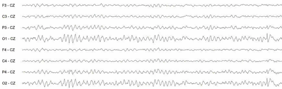 اسپایک‌ها، اکسیپیتال چپ