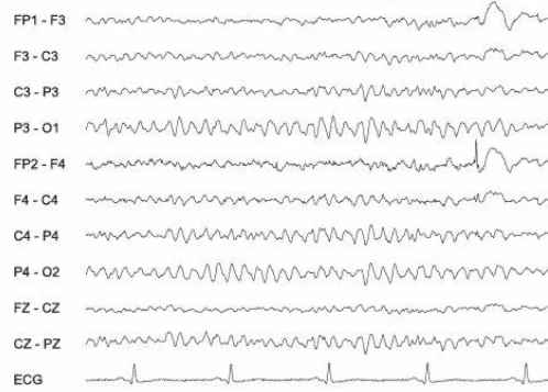 آرتیفکت‌های عضلانی پیشانی