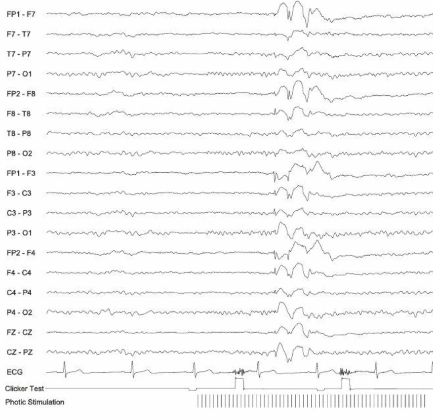 پاسخ فوتوپاروکسیسمال، ژنرالیزه