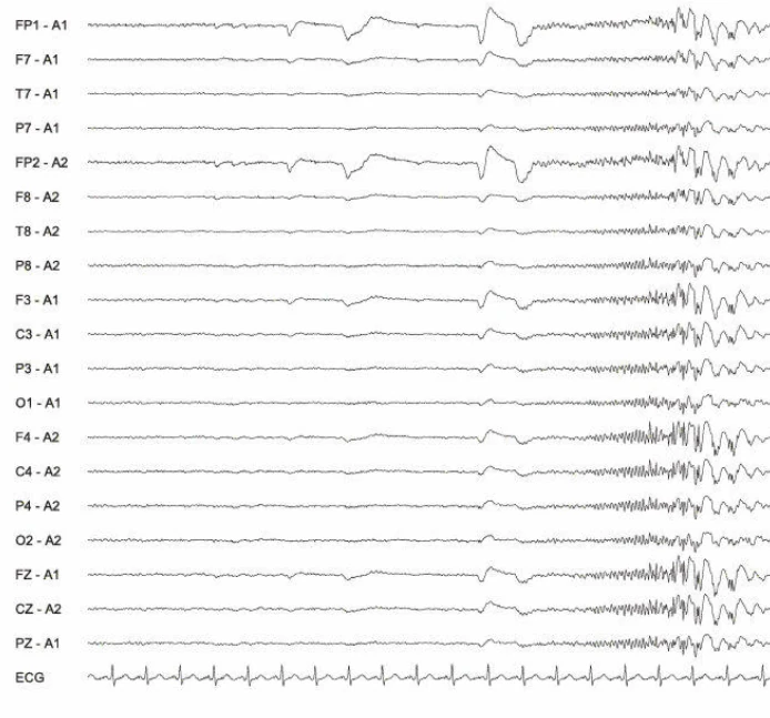 پلی‌اسپایک-ویو (PSW)