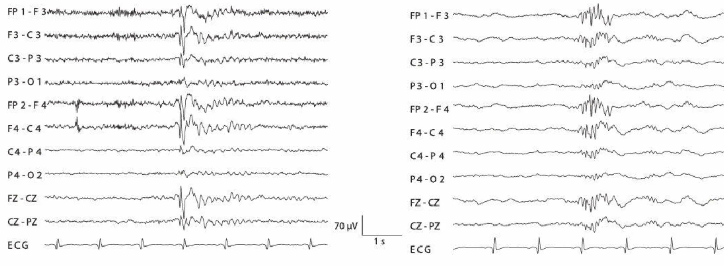 پلی‌اسپایک‌های ژنرالیزه