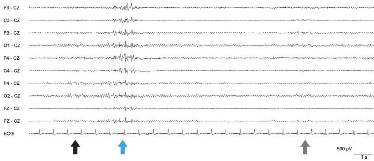 اسپایک‌ها در بیداری، پلی‌اسپایک‌ها در خواب