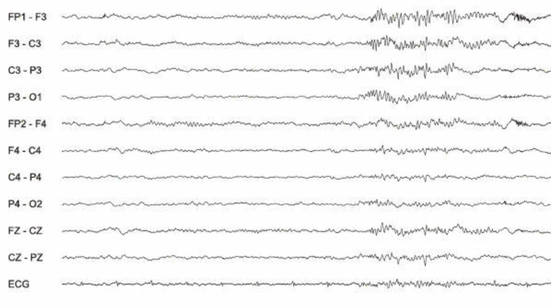 پاروکسیسم سریع، نیمکره چپ