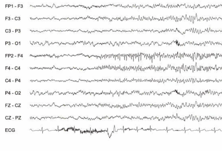 پاروکسیسم سریع، فرونتال راست