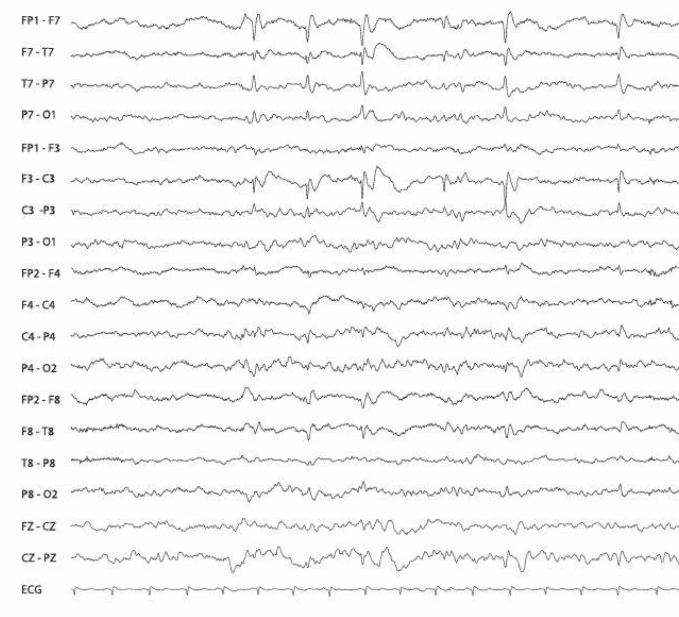 نمودار EEG نشان‌دهنده دشارژهای صرعی کانونی خوش‌خیم در ناحیه تمپوروسنترال چپ