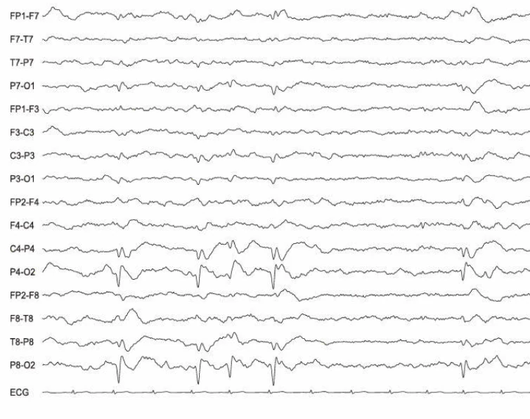 نمودار EEG نشان‌دهنده دشارژهای صرعی کانونی خوش‌خیم در ناحیه اکسیپیتال راست