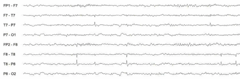 نمودار EEG مقایسه‌ای دشارژهای صرعی در نواحی تمپورال راست و چپ