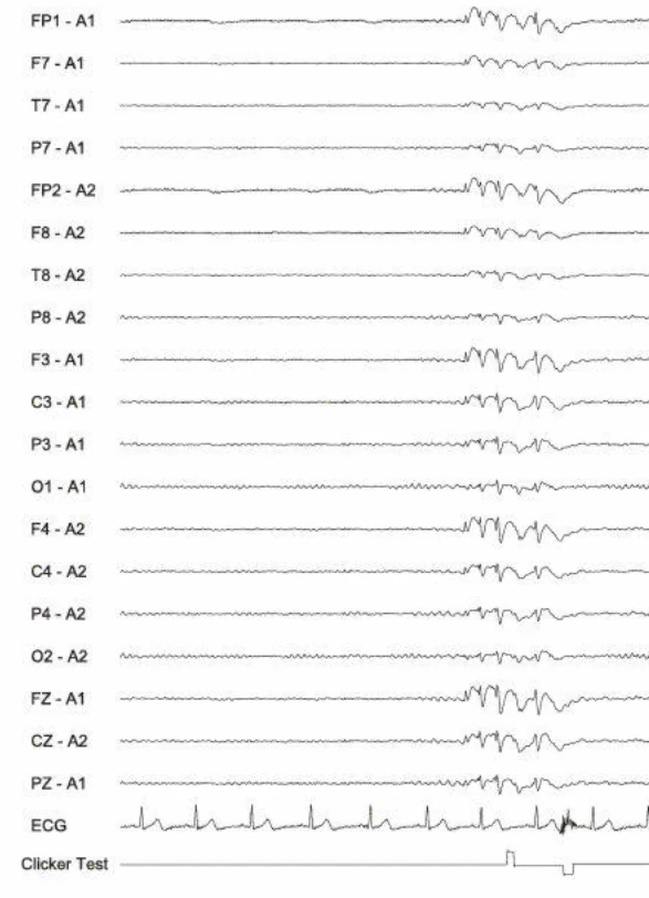 اسپایک-ویوها، ژنرالیزه؛ تشنج آکینتیک