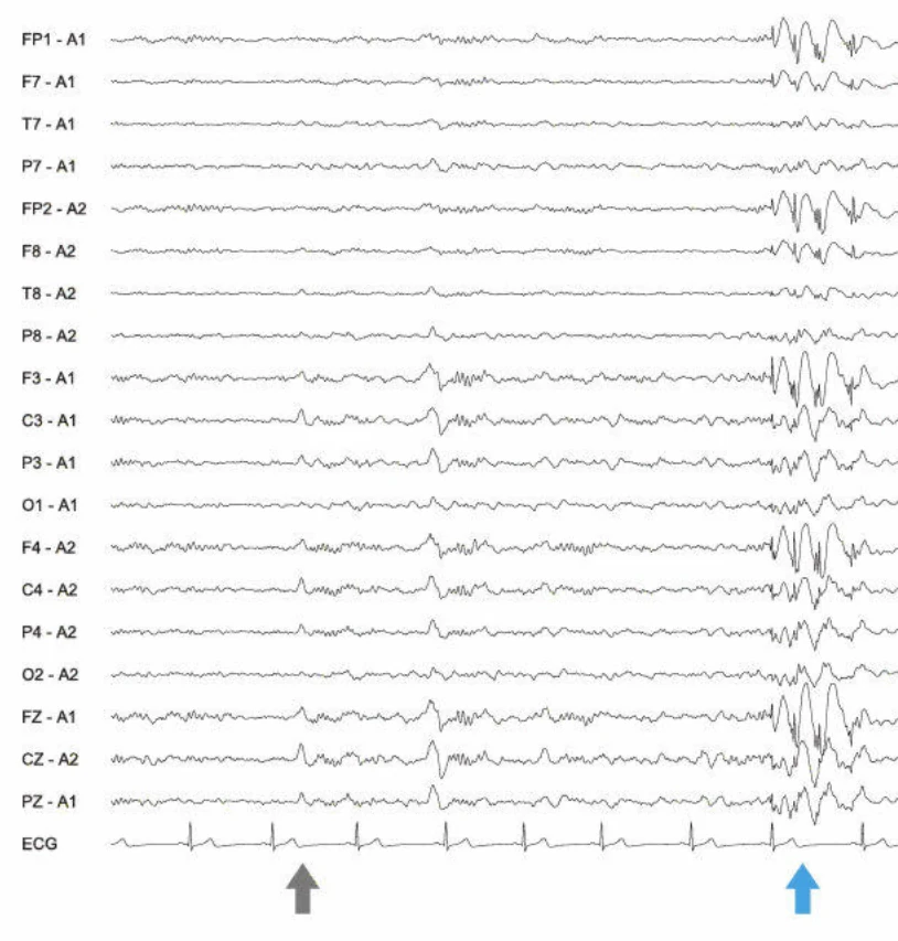 اسپایک-ویوها همراه با کمپلکس‌های K
