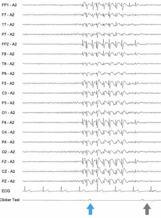 اسپایک-ویوها، ژنرالیزه؛ تشنج دیالپتیک