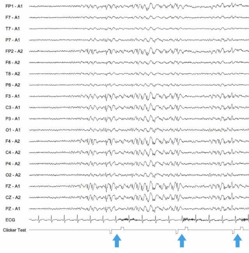 اسپایک-ویوهای ۳ هرتز، ژنرالیزه