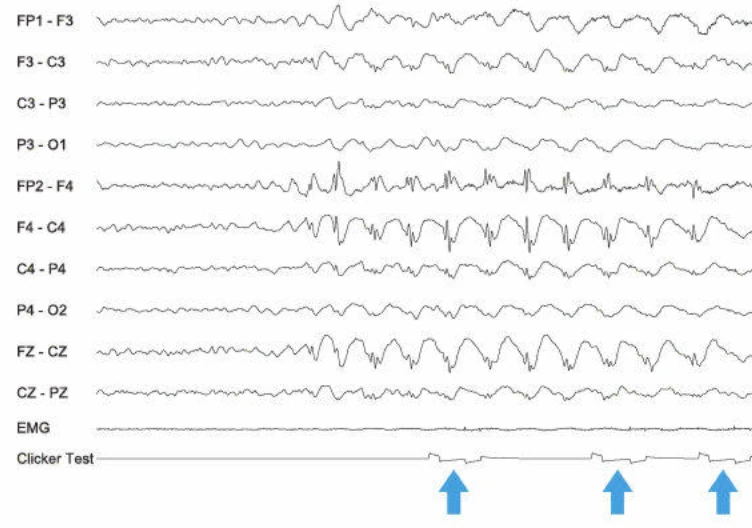 اسپایک-ویوها، فرونتال راست