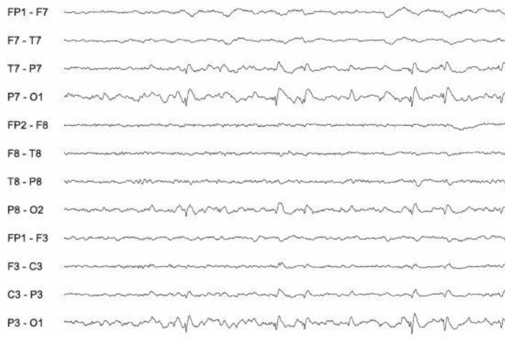 اسپایک-ویوها، اکسیپیتال چپ و آهسته مداوم تمپورال چپ