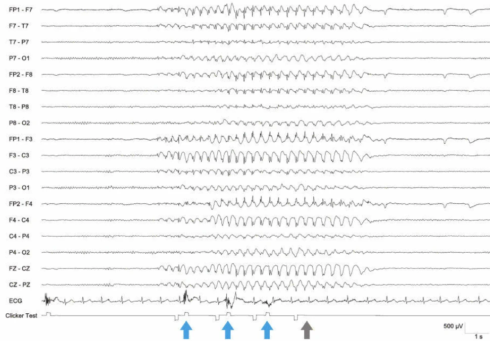 اسپایک-ویو ۳ هرتز، ژنرالیزه