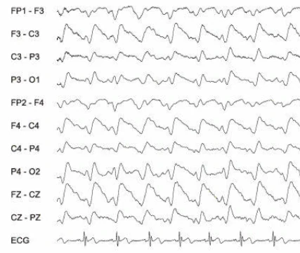 اسپایک-ویو آهسته، ژنرالیزه