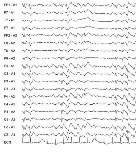 اسپایک-ویو آهسته، ژنرالیزه با مرجع گوش