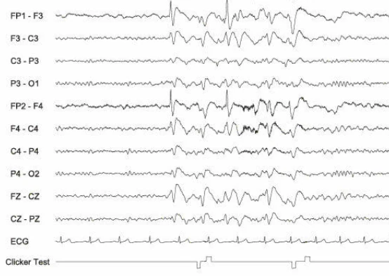اسپایک-ویو آهسته، ژنرالیزه و آهسته مداوم