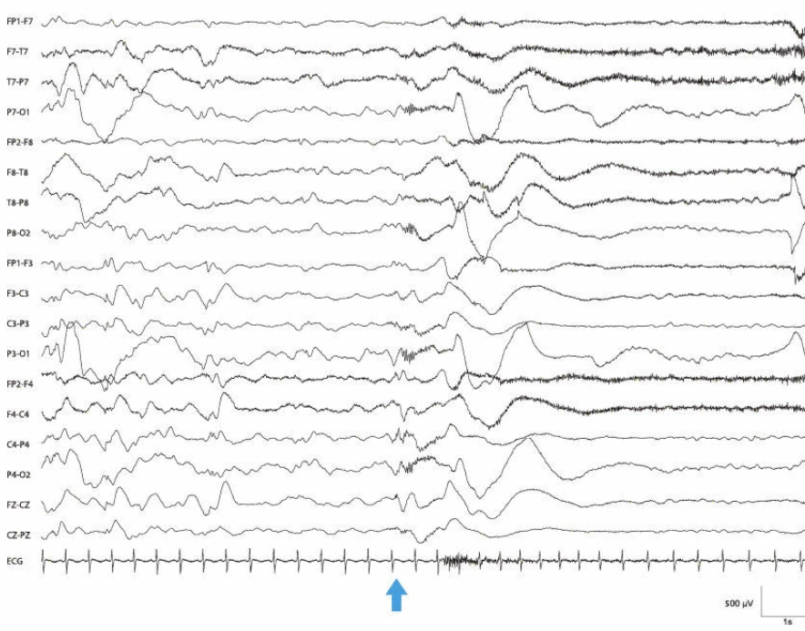 مسطح شدن EEG در هیپس‌آریتمی