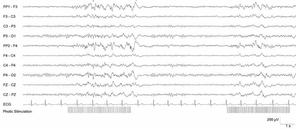 پاسخ فوتوپاروکسیسمال II