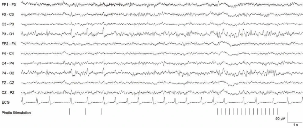 فوتایک درایوینگ در دمانس آلزایمر