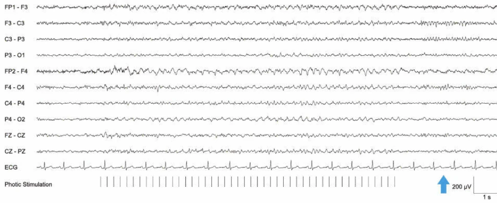فوتایک درایوینگ در آموروزیس مادرزادی