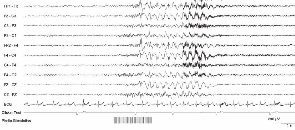 پاسخ فوتوپاروکسیسمال III