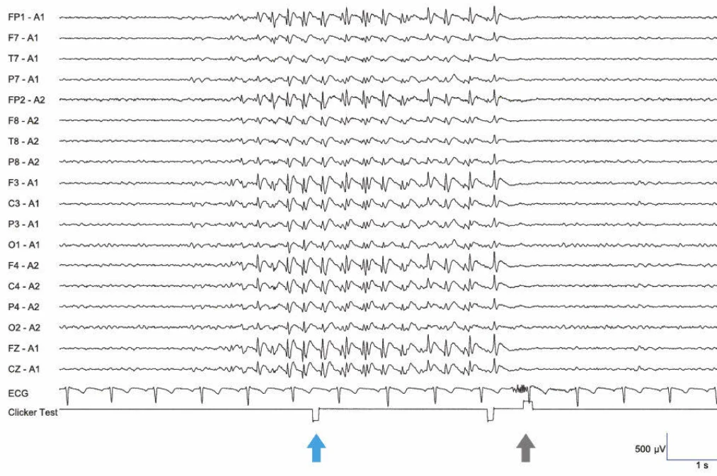 الگوی تشنج EEG ژنرالیزه - صرع ابسانس